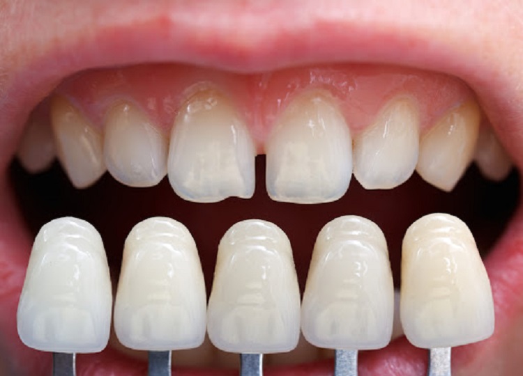 هر آنچه درباره لمینت دندان باید بدانید